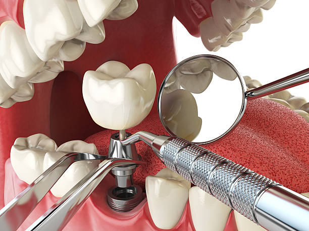 Best Emergency Wisdom Tooth Extraction in Trucksville, PA